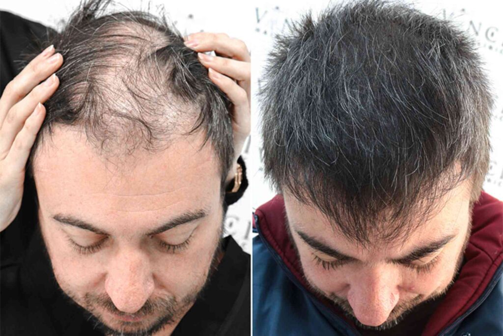 Hair Transplant Turkey
